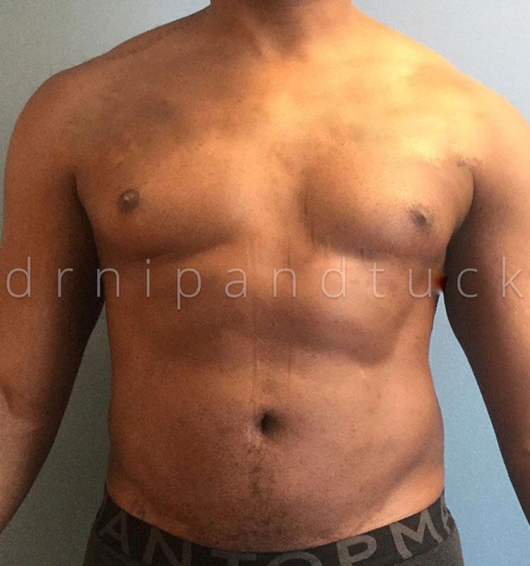 Before and After