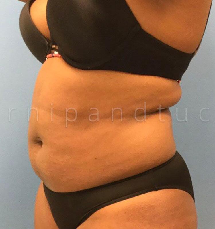 Before and After