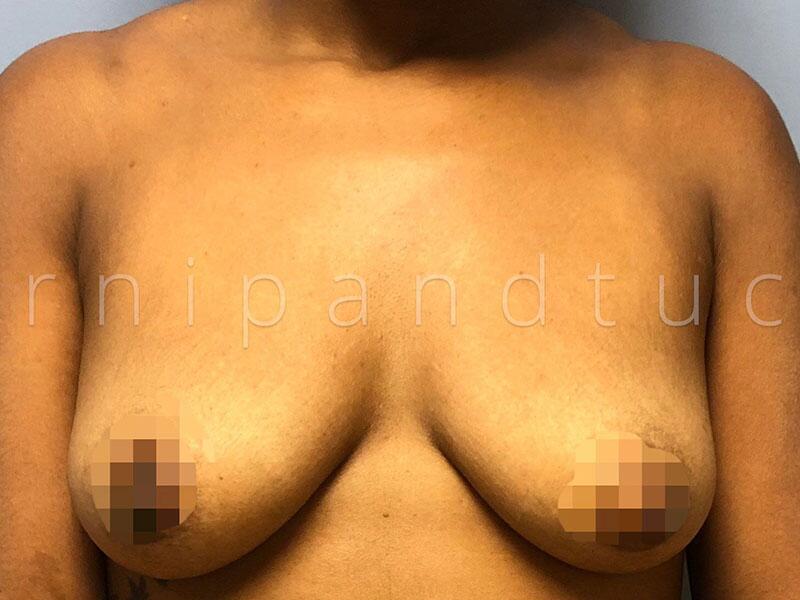 Before and After