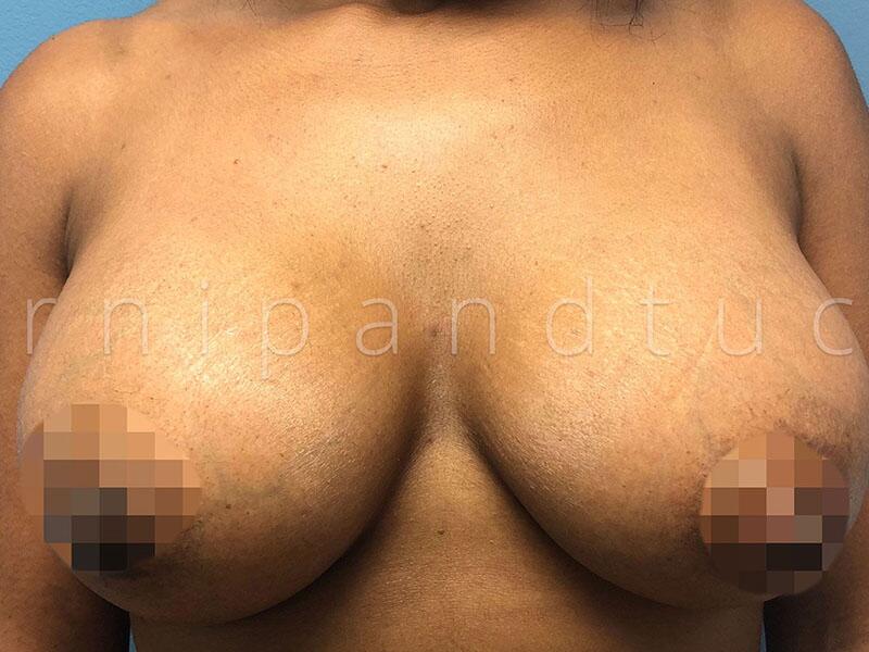 Before and After